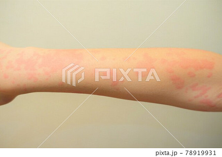蕁麻疹が出た子ども　じんましん　 78919931