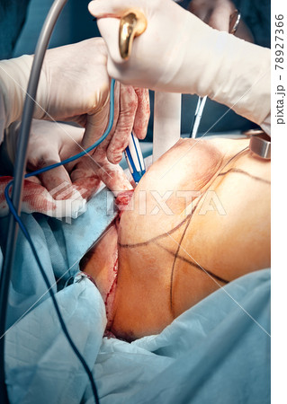 The doctor performs an operation to reconstruct the female breast. Close-up of plastic surgeon performing implantation procedure, breast cancer 78927366