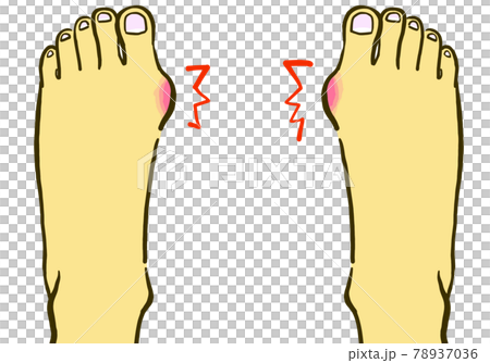 因拇外翻而受傷的腳的線條圖插圖 78937036