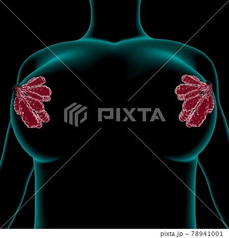 Female breast cancer, illustration