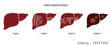 Liver disease concept 78947900