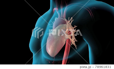 Abdominal aorta, Rupture of an abdominal aortic aneurysm 78961831