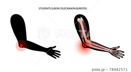 Student elbow bursitis 78982571