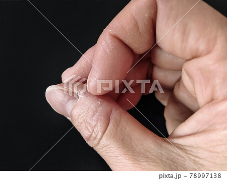 指の皮をむしる 78997138