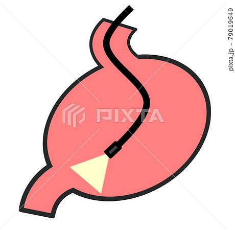 健康診断で胃カメラを使用して精密検査をするイラスト 79019649