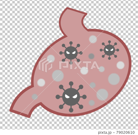 ウイルスに感染して病気になった胃のイラスト 79020610