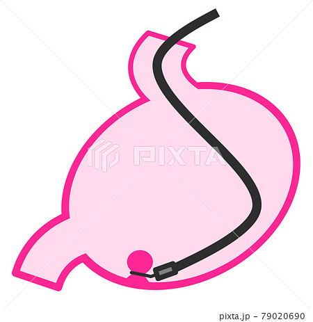 胃のポリープを内視鏡で切除する手術のイラスト 79020690