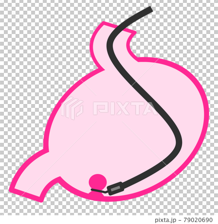 胃のポリープを内視鏡で切除する手術のイラスト 79020690