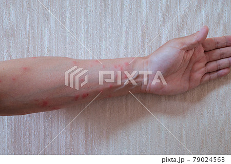 毛虫皮膚炎 79024563