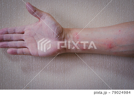 毛虫皮膚炎 79024984