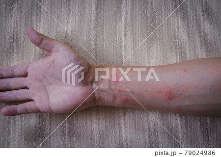 毛虫皮膚炎 毛虫皮膚炎 79024986