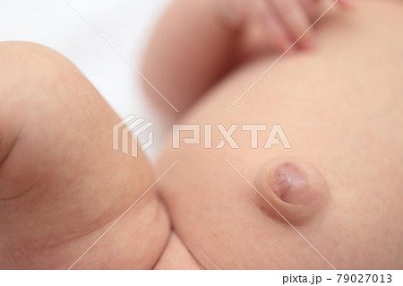 臍ヘルニアの赤ちゃんのおへそ 79027013