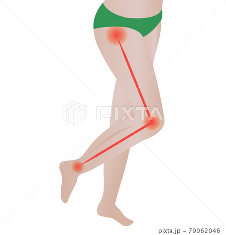 Joint pain. Sciatic Nerve. sciatic back pain. vector illustration 79062046