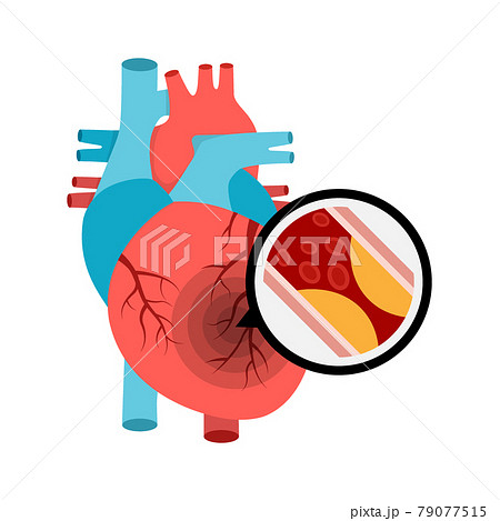 Human heart anatomy with heart attack. Atherosclerotic plaque in the blood vessels. Human heart anatomy with heart attack. Atherosclerotic plaque in the blood vessels. 79077515