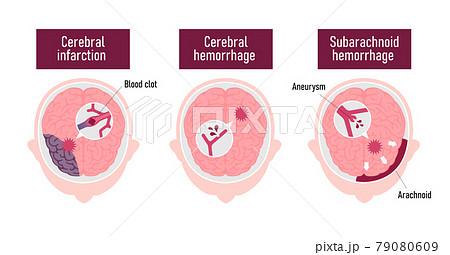 脳卒中 脳梗塞 脳出血 くも膜下出血 の原因と症状 図解ベクターイラスト 英語 のイラスト素材