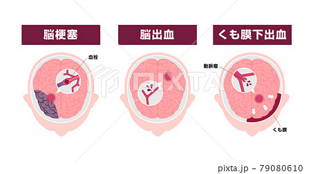 脳卒中 脳梗塞 脳出血 くも膜下出血 の原因と症状 図解ベクターイラストのイラスト素材