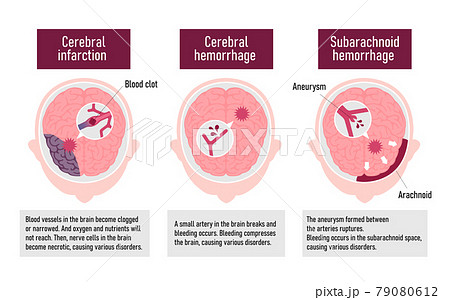 脳卒中 脳梗塞 脳出血 くも膜下出血 の原因と症状 図解ベクターイラスト 英語 解説文つき のイラスト素材