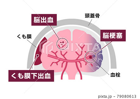 脳卒中 脳梗塞 脳出血 くも膜下出血 の原因と症状 図解ベクターイラストのイラスト素材