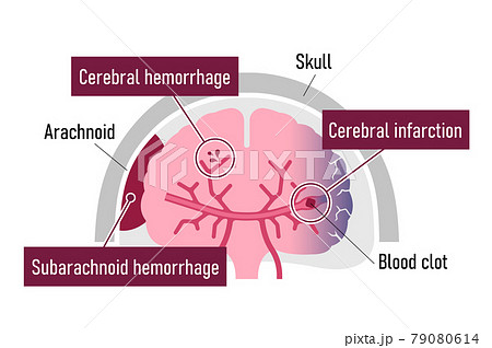 脳卒中 脳梗塞 脳出血 くも膜下出血 の原因と症状 図解ベクターイラスト 英語 のイラスト素材