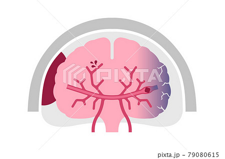 脳卒中 脳梗塞 脳出血 くも膜下出血 の原因と症状 図解ベクターイラスト 文字なし のイラスト素材