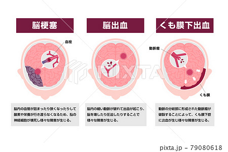 脳卒中 (脳梗塞・脳出血・くも膜下出血) の原因と症状　図解ベクターイラスト (解説文つき) 79080618