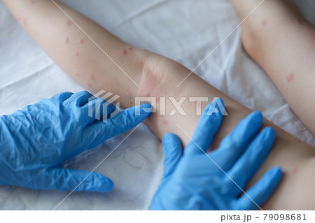 Doctor dermatologist in rubber gloves examining rash on skin of child feet closeup Doctor dermatologist in rubber gloves examining rash on skin of child feet closeup 79098681