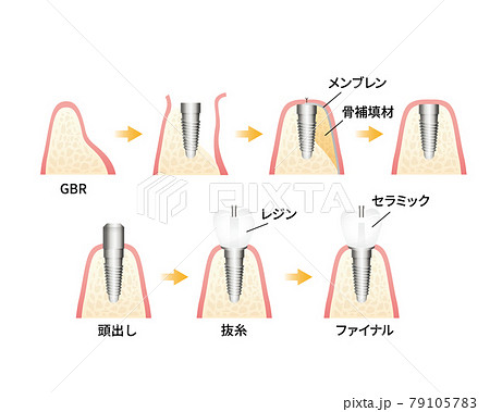インプラント治療イラスト（歯・歯茎） 79105783