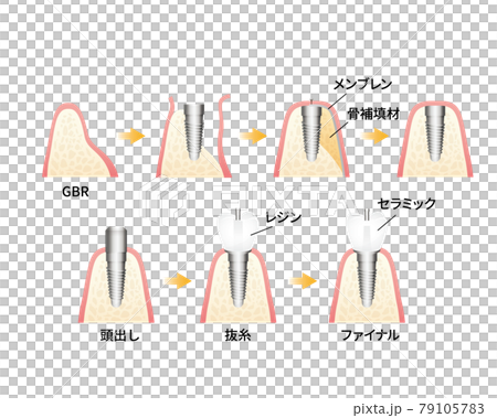 インプラント治療イラスト（歯・歯茎） 79105783