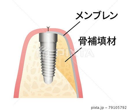 インプラント治療イラスト（歯・歯茎） 79105792