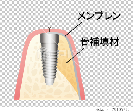 インプラント治療イラスト（歯・歯茎） 79105792