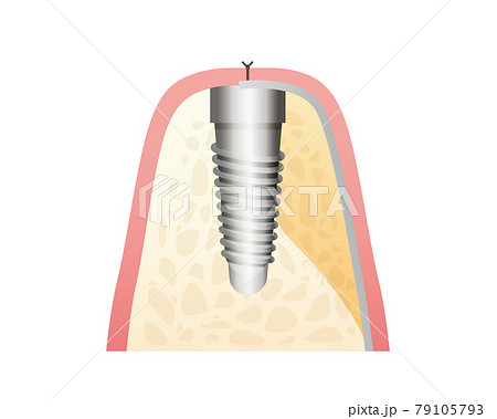 インプラント治療イラスト(歯・歯茎) インプラント治療イラスト(歯・歯茎) 79105793