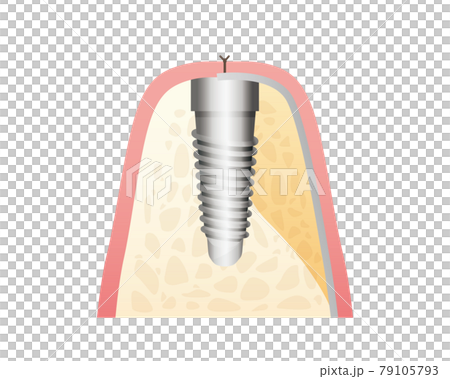 インプラント治療イラスト(歯・歯茎) インプラント治療イラスト(歯・歯茎) 79105793