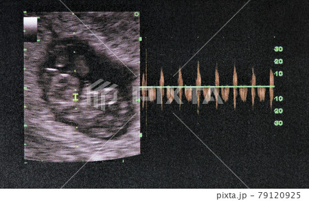 picture of Ultrasound of baby in mother's womb. 24 week. picture of Ultrasound of baby in mother's womb. 24 week. 79120925