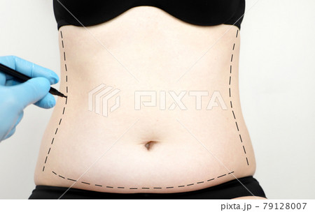 Abdominoplasty and torsoplasty: abdominal liposuction and removal of the apron. The patient at the reception at the plastic surgeon 79128007