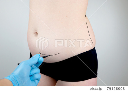 Abdominoplasty and torsoplasty: abdominal liposuction and removal of the apron. The patient at the reception at the plastic surgeon Abdominoplasty and torsoplasty: abdominal liposuction and removal of the apron. The patient at the reception at the plastic surgeon 79128008