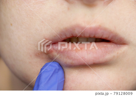 Herpes on the lips: a woman with a cold and the herpes virus is examined by a dermatologist and infectious disease specialist Herpes on the lips: a woman with a cold and the herpes virus is examined by a dermatologist and infectious disease specialist 79128009