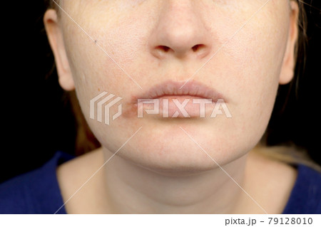 Herpes on the lips: a woman with a cold and the herpes virus is examined by a dermatologist and infectious disease specialist Herpes on the lips: a woman with a cold and the herpes virus is examined by a dermatologist and infectious disease specialist 79128010