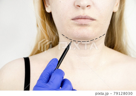 Mentoplasty: plastic chin. Patient before chin and neck surgery. Plastic surgeon advises 79128030
