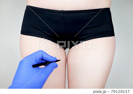 Plastic surgery: femoroplasty, cruroplasty, buttocks endoprosthetics, gluteoplasty. Patient on consultation with a plastic surgeon 79129237