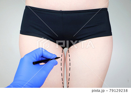 Plastic surgery: femoroplasty, cruroplasty, buttocks endoprosthetics, gluteoplasty. Patient on consultation with a plastic surgeon Plastic surgery: femoroplasty, cruroplasty, buttocks endoprosthetics, gluteoplasty. Patient on consultation with a plastic surgeon 79129238