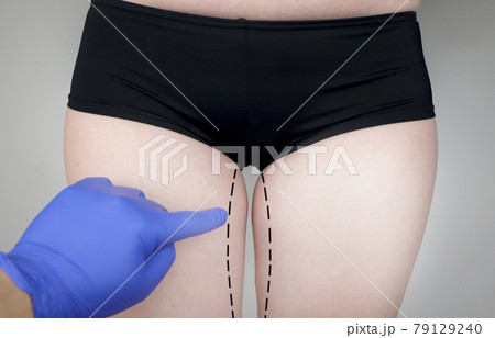 Plastic surgery: femoroplasty, cruroplasty, buttocks endoprosthetics, gluteoplasty. Patient on consultation with a plastic surgeon 79129240