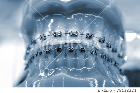 Braces on a model of human teeth, dental tooth dentistry close-up. Braces on a model of human teeth, dental tooth dentistry close-up. 79133221