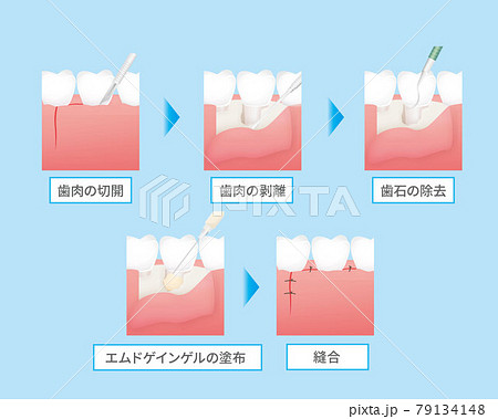 歯の治療のイラスト エムドゲインゲル のイラスト素材