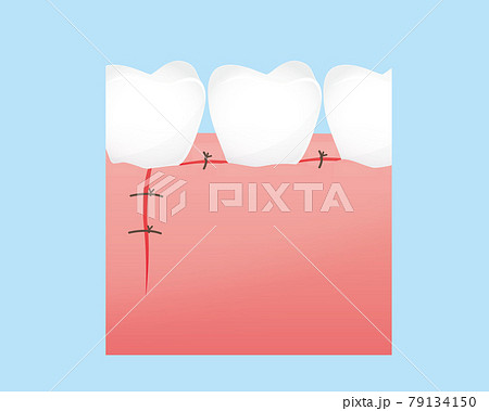 歯の治療のイラスト（エムドゲインゲル） 79134150