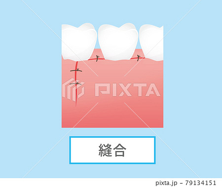 歯の治療のイラスト エムドゲインゲル のイラスト素材