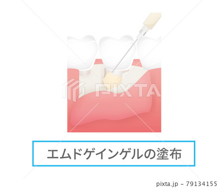 歯の治療のイラスト(エムドゲインゲル) 歯の治療のイラスト(エムドゲインゲル) 79134155