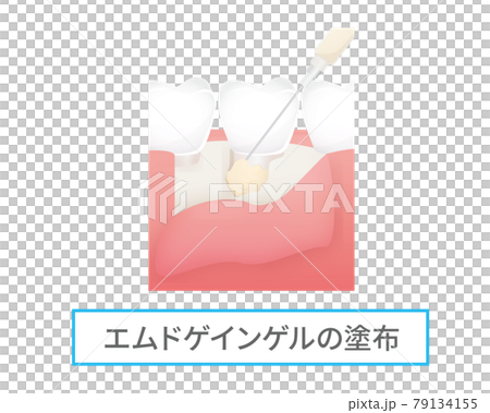 Illustration of dental treatment (Emdgain gel) Illustration of dental treatment (Emdgain gel) 79134155