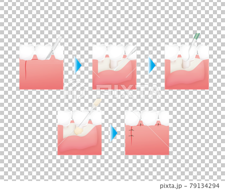 歯の治療のイラスト エムドゲインゲル のイラスト素材