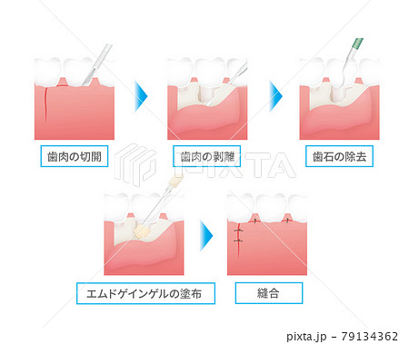 歯の治療のイラスト（エムドゲインゲル） 79134362