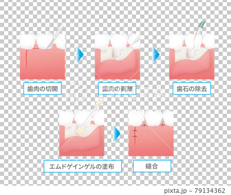 Illustration of dental treatment (Emdgain gel) 79134362